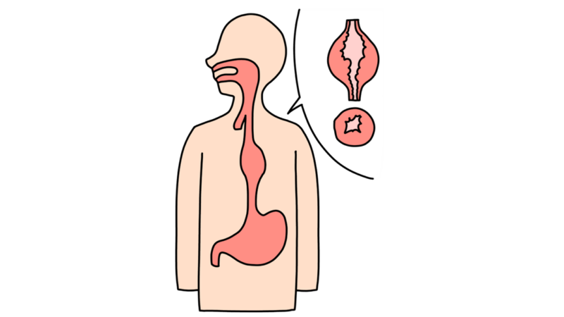 食道がんのアイキャッチ画像