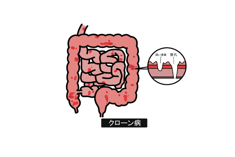 消化管全体に炎症が及ぶ慢性疾患：クローン病のアイキャッチ画像