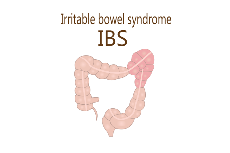 過敏性腸症候群（IBS）を理解する：症状・原因・対策のポイントのアイキャッチ画像