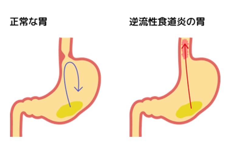胃酸の逆流を抑えるために：逆流性食道炎（GERD）のアイキャッチ画像