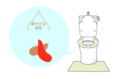 【血便・便潜血】おしりからの出血を痔だと決めつけないで。医師が解説する原因と対処法のアイキャッチ画像