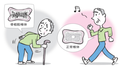男性の骨粗鬆症|見逃されやすい原因・症状・治療を解説のアイキャッチ画像