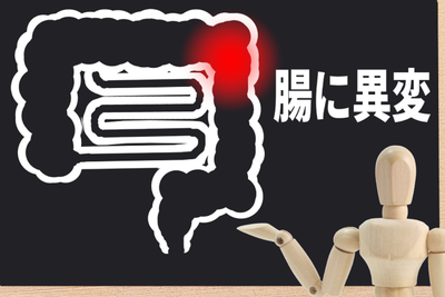 大腸がんの初期症状と気づきにくいサイン｜便の変化・腹痛・血便を見逃すなのアイキャッチ画像